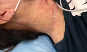 Phản vệ sau ăn hải sản